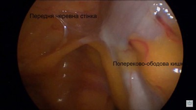 Фото 4. Фіксація злуками попереково-ободової кишки до черевної стінки