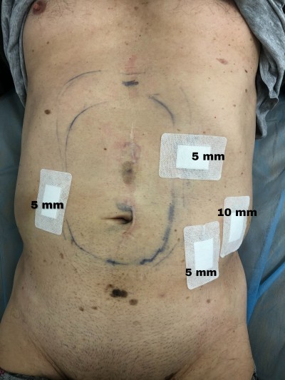 Фото 8. Розташування проколів, через які виконано втручання на передній черевній стінці